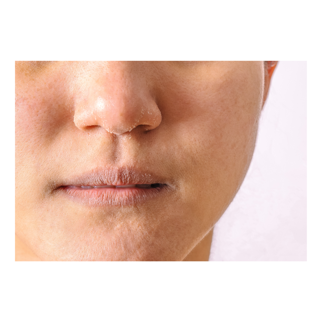 How to Moisturize Dry Skin